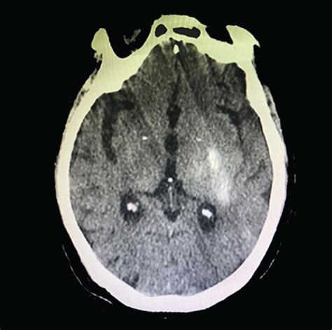 Images Of Post Procedure Flat Panel Ct A And Non Contrast Ct B In