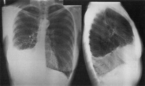 Pulmonary Tuberous Sclerosis Chest