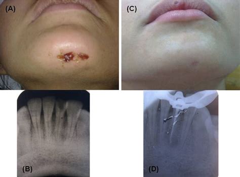 Conservative Management Of Persistent Facial Cutaneous Sinus Tract With