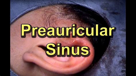 Preauricular Ear Sinus Infection Youtube