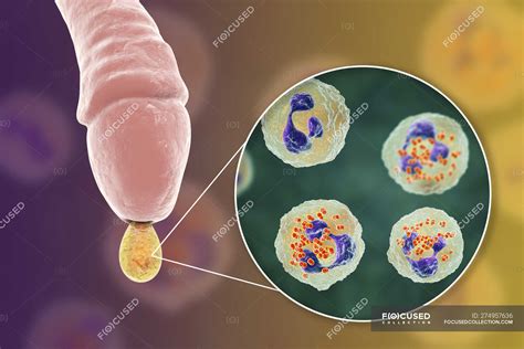 Gonorrhoea Infection Causing By Bacteria Neisseria Gonorrhoeae In Male