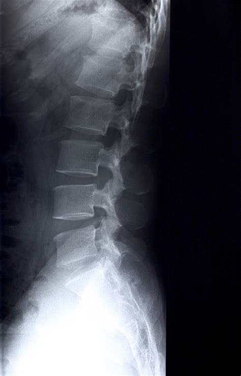 Normal Lateral Spine X Ray