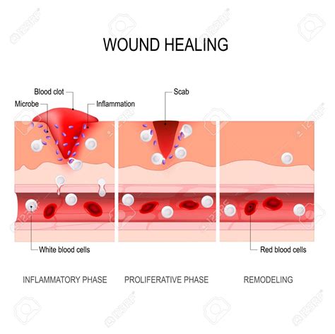 Wound Healing Process Healers B04
