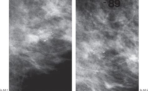 Differential Diagnosis Of Breast Diseases Producing Clustered Discernible Calcifications