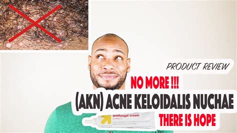 Treatment Cure For Acne Keloid Nuchae Or The Bumps On The Back Of