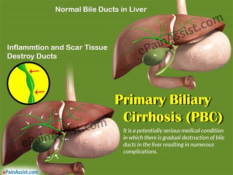 Primary Biliary Cirrhosis Pbc Treatment Home Remedies Causes