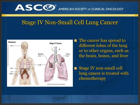 lung cancer non small cell stage 4