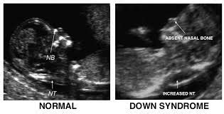 Nice try is the least common of the three meanings. Nuchal Translucency (NT) Normal Range | New Health Advisor