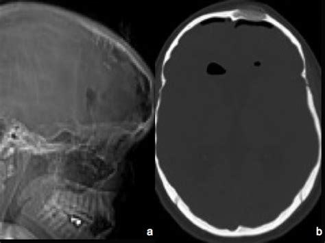 Another Calvarial Hemangioma In Young Women Presenting With Frontal