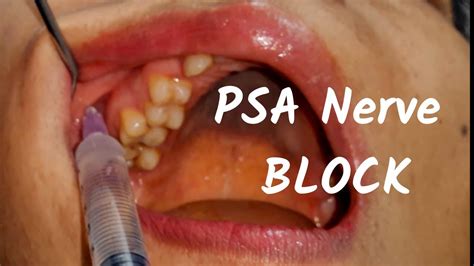 Posterior Superior Nerve Block Psa Inj In Dentistry Landmark