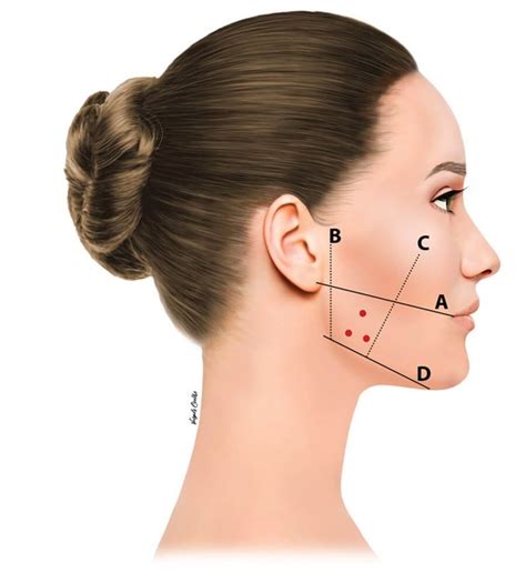 Management Of Masseter Hypertrophy And Bruxism With Botulinum Toxin A
