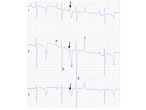 Electrocardiogram With 3 Lead Recording 13 Showing An Atrial
