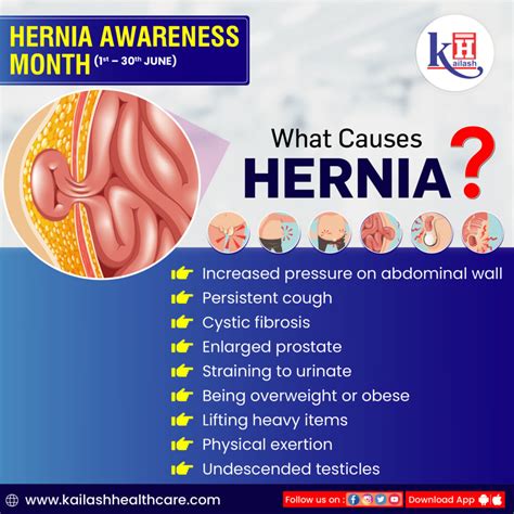 A Hernia Occurs When An Organ Pushes Through An Opening In The Muscle