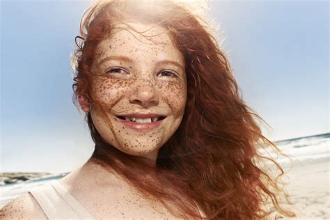 Where Do Freckles Come From Facty Health