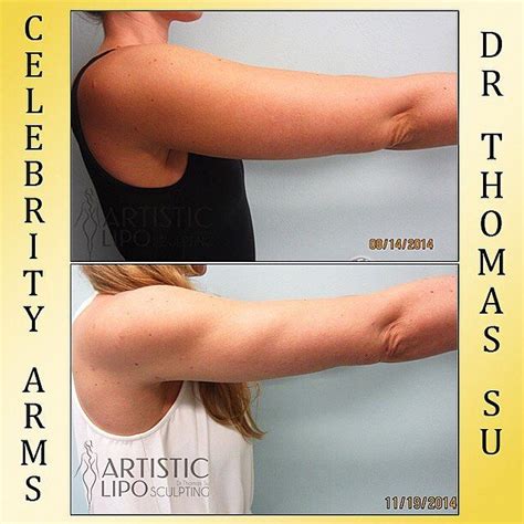 Revolutionary💥 Celebrity Arms Liposuction Celebrityarmsliposuction