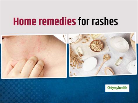 11 Effective Home Remedies For Treating Rashes On Infants Face Rash On