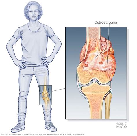Bone Cancer Disease Reference Guide
