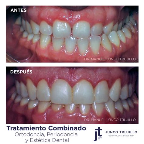 Caso Tratamiento Combinado Ortodoncia Periodoncia Y Estética Dental