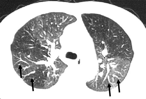 Long Term Survivor With Pulmonary Veno Occlusive Disease Circulation