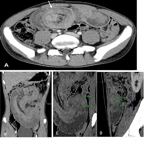 Cureus Multidetector Computed Tomography Findings Of Acute Abdominal