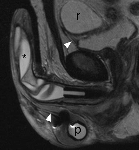 Mr Imaging Of Nonmalignant Penile Lesions Radiographics