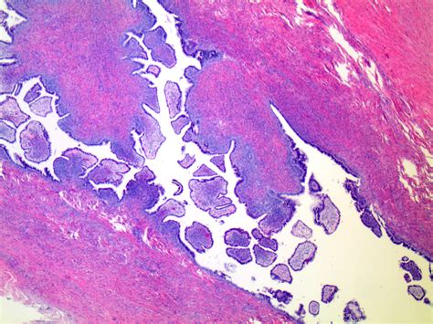 Pathology Outlines Serous Cystadenoma Adenofibroma And Surface Papilloma