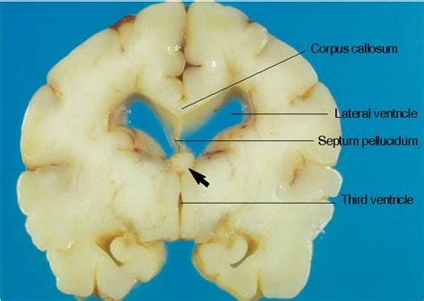 Figure 1 From Absence Of The Septum Pellucidum Associated With A