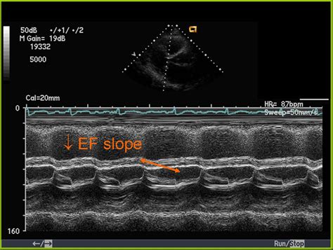 Colour Doppler Echocardiogram In Mitral Stenosis All
