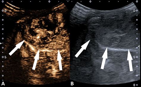 Cureus Contrast Enhanced Ultrasound For The Characterization Of