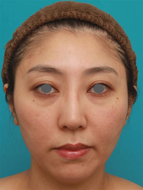 小顔専用脂肪溶解注射メソシェイプフェイスで頬、フェイスライン、顎下の皮下脂肪を溶かした30代後半女性の症例写真：美容外科 高須クリニック