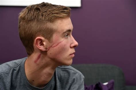 Teenager Scarred For Life In Bottle Attack Slams Justice System As
