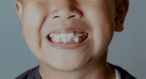 Having Crooked Teeth Creates Risk For Dental Issues Down The Road