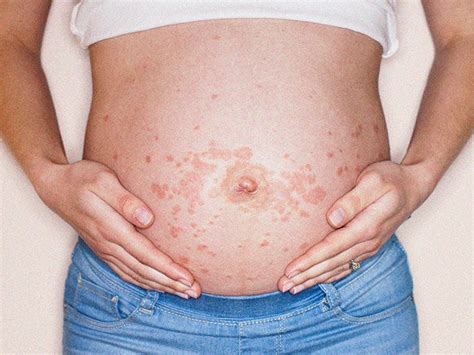 Types Of Pregnancy Rash Symptoms And What They Look Like