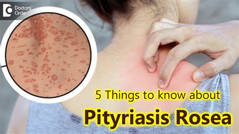 5 Things To Know About Pityriasis Rosea Pityriasis Rosea Rash Dr
