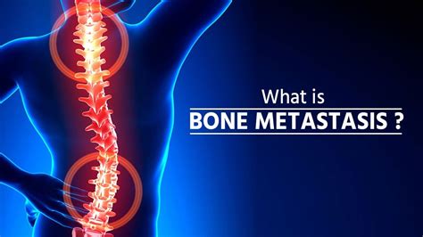 What Is Bone Metastasis Stage 4 Cancer Bone Metastasis How Cancer
