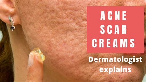 Acne Scar Creams Dermatologist Reviews Youtube