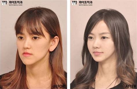 Korean Women Plastic Surgery Tops Entertainment