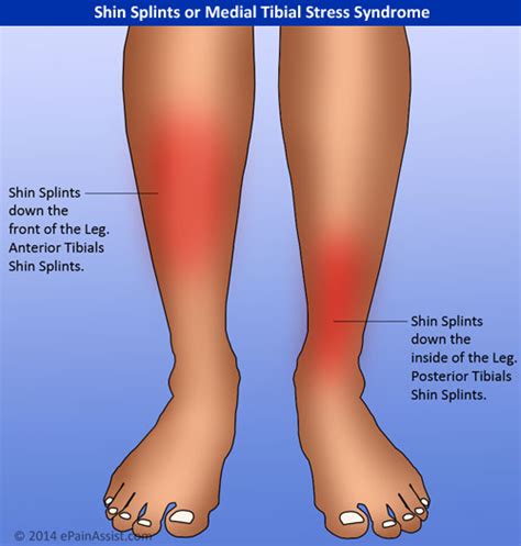 Medial Tibial Stress Syndrome Treatment Causes Symptoms