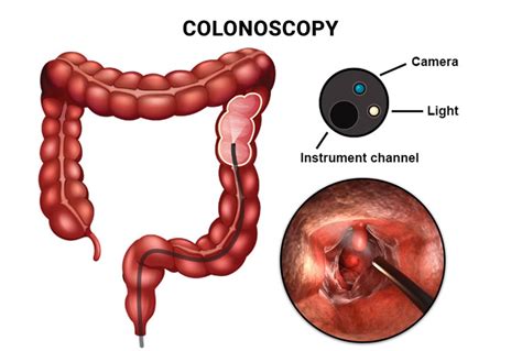 Prep Instructions For Your Colonoscopy Manhattan Gastroenterology