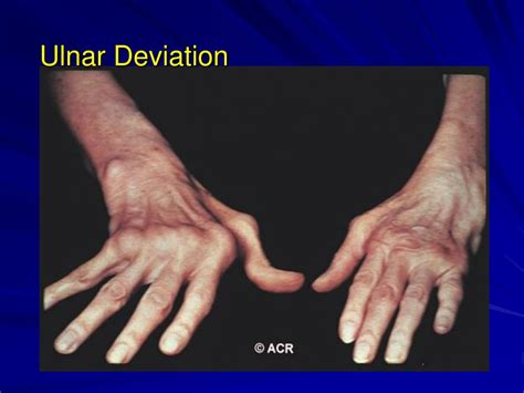 Ppt Rheumatoid Arthritis 1105 Powerpoint Presentation Free Download