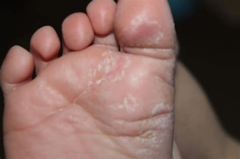 Athletes Foot Fungus Foot Fungus Treatment Dry Skin Treatment Dry