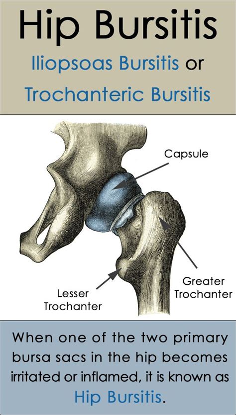 Bursitis Of The Hip Trochanteric And Iliopsoas Bursitis Hip Hip