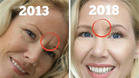 How To Get Rid Of Frown Lines Between Eyes Beauty Over 40 Youtube