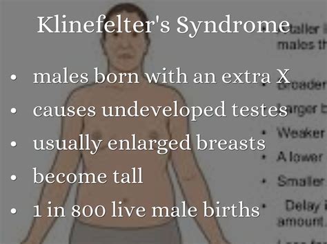 klinefelter syndrome what is klinefelter syndrome sexiz pix
