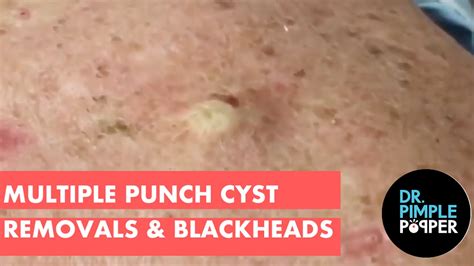 Multiple Punch Removals Of Cysts On The Back And Blackhead Extractions Bedtime Blackheads Dr
