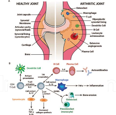 Pictures Autoimmune Diseases Rheumatoid Arthritis