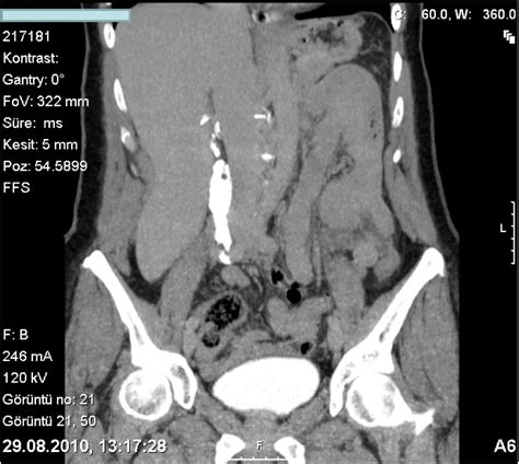 Spontaneous Rupture Of Ureter An Unusual Cause Of Acute Abdominal Pain