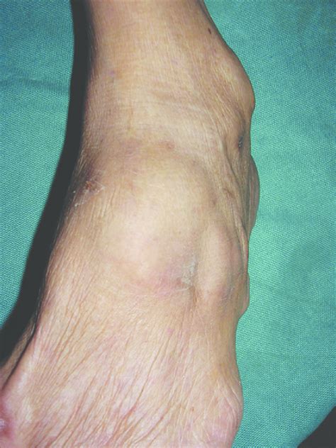A Smooth Lobulated Swelling On The Dorsum Of Left Foot Download