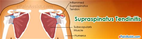 Supraspinatus Rupture Treatment Causes Symptoms Diagnosis Sexiezpix