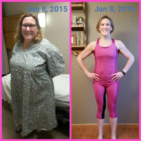 Before After 1 Year Gastric Sleeve Anniversary Member Photo Gallery Bariatricpal